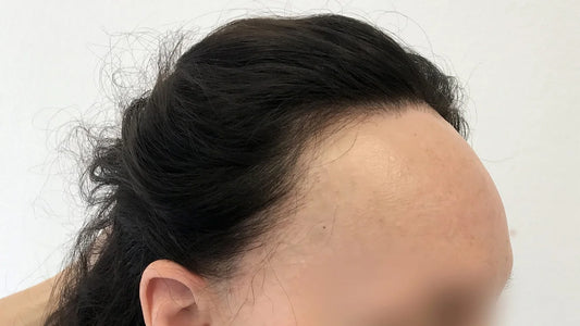 Frontale Fibroserende Alopecie