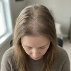 Diffuser Haarausfall bei Frauen